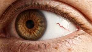 Broken Blood Vessel in Eye: Causes and Healing